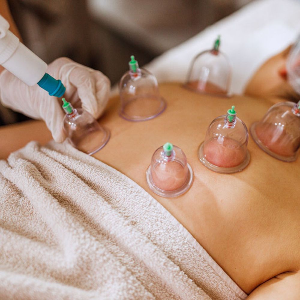 Cupping Therapy